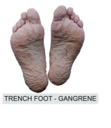 trench foot