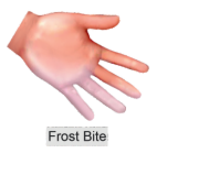 frost bite