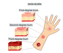 Classification of burn