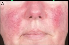 Erythematotelangiectatic rosacea