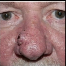 Phymatous rosacea (PR)