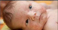 Neonatal Acne