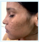 Grading of Acne 