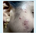 Comedones + Inflammatory papules