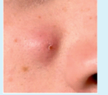 Comedones + Multiple Inflammatory papules and pustules