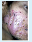 Nodulocystic acne