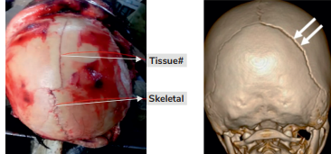 Diastatic fracture