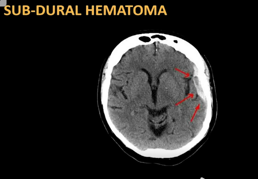 Subdural Hematoma