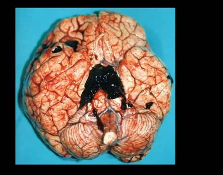 Intracerebral Hemorrhage