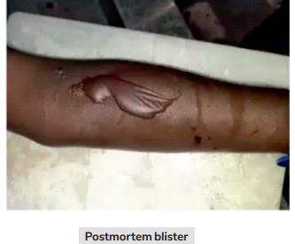 postmortem blister