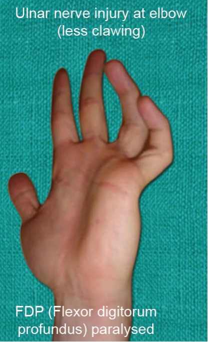Ulnar Nerve Lesions Causes Diagnosis And FAQs