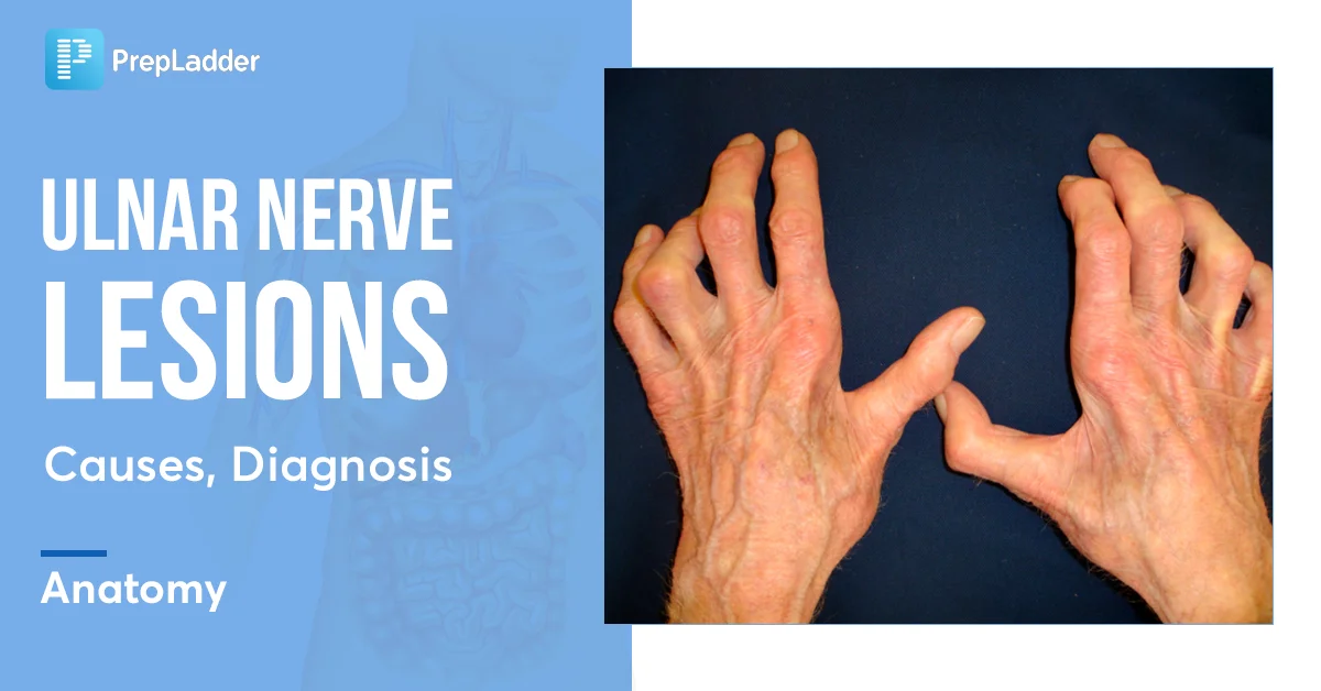 Ulnar Nerve Damage