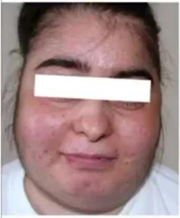 Clinical Features Cushing Syndrome
