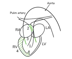 Overriding of aorta tetralogy of Fallot