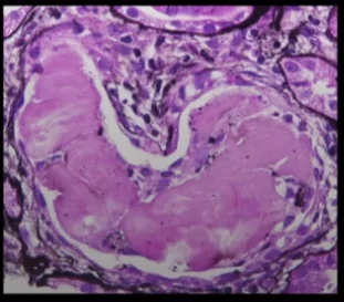 Types of Amyloidosis