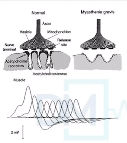 Repetitive Nerve Stimulation test 