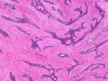  Intracanalicular fibroadenoma