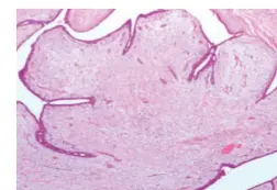  Phyllodes Tumor 