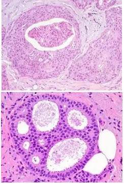 Cribriform Patterns of Ductal Carcinoma In Situ