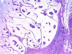 Biopsy findings of mucinous carcinoma