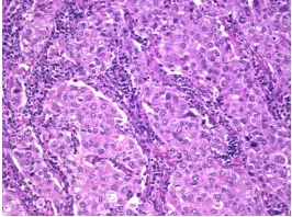 Medullary carcinoma