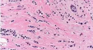  Microscopy of Invasive Lobular Carcinoma