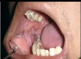 Oral lesions