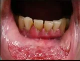 Oral Mucosa