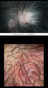 Cicatricial / Scarring alopecia