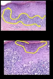 Hyperkeratosis