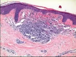 Lichenoid Papules