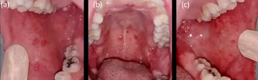 Prodromal phase