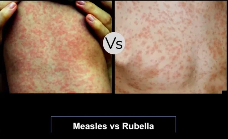 Measles vs Rubella rash 