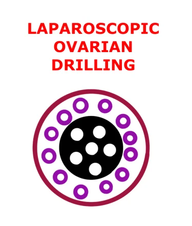 Laparoscopic Ovarian Drilling