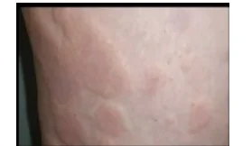 urticaria
