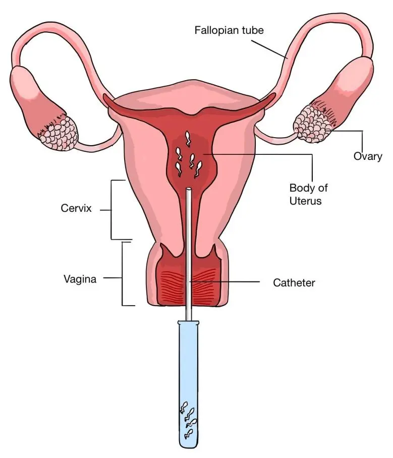 IntraUterine Insemination