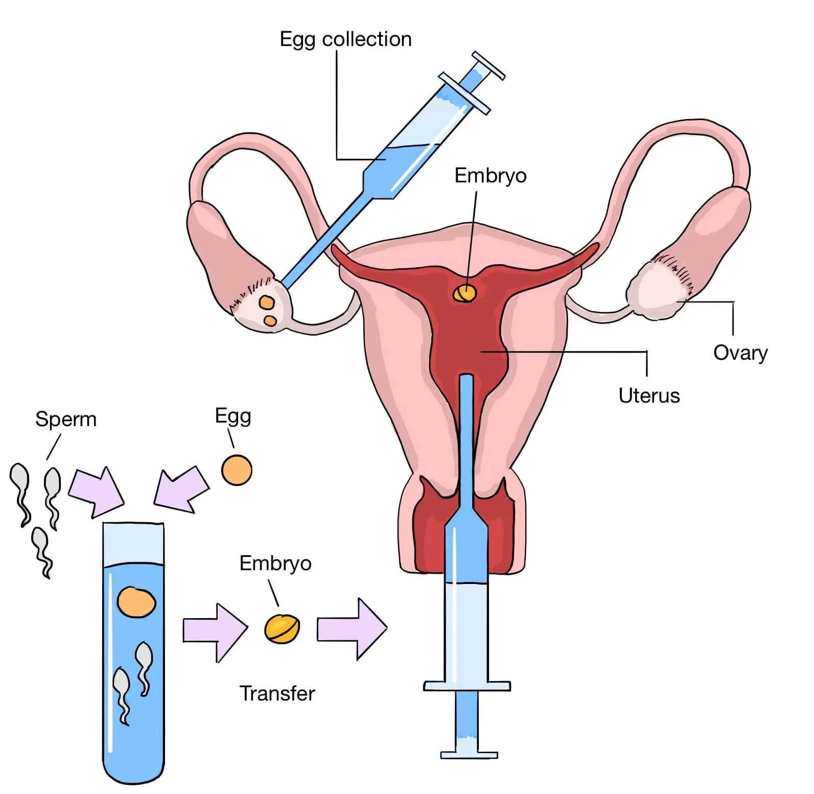 In Vitro Fertilization