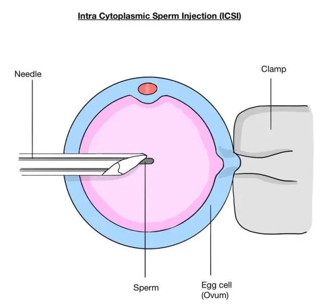 IntraCytoplasmic Sperm Injection