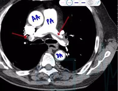 Pulmonary Thromboembolism
