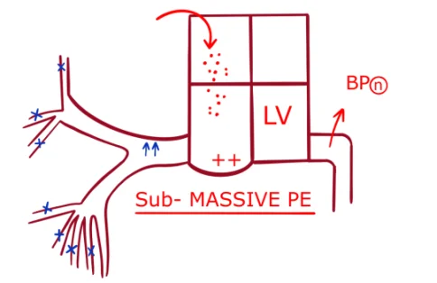 Sub-Massive Pulmonary Embolism
