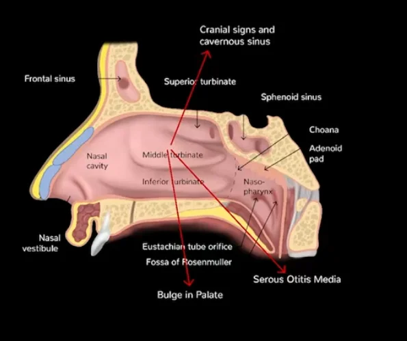 Cranial spread