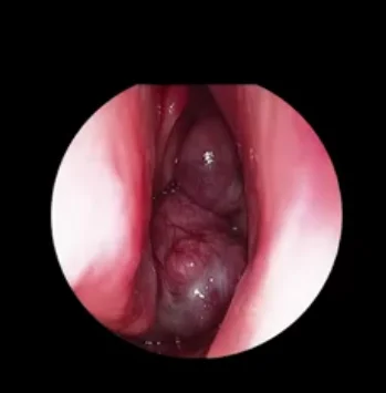 Clinical Examination Of Juvenile Nasopharyngeal Angiofibroma