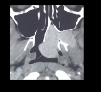 Role of CT scan