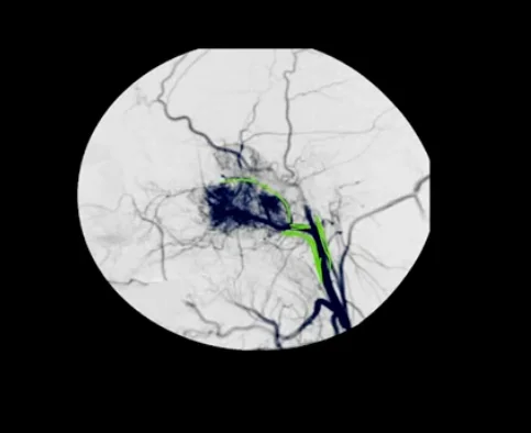 Role of Angiography