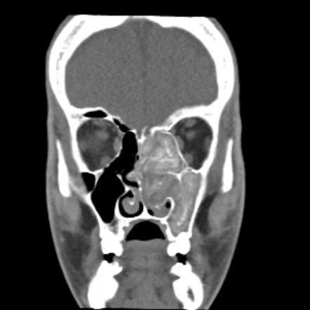 AFRS (Allergic Fungal Rhino Sinusitis)