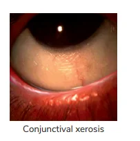 Conjunctival xerosis (X1A) 