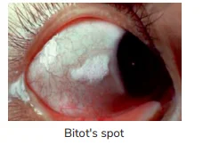 Bitot's spot (X1B) 