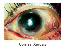 Corneal Xerosis(X2) 