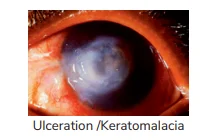 Ulceration /Keratomalacia (3 A, B)