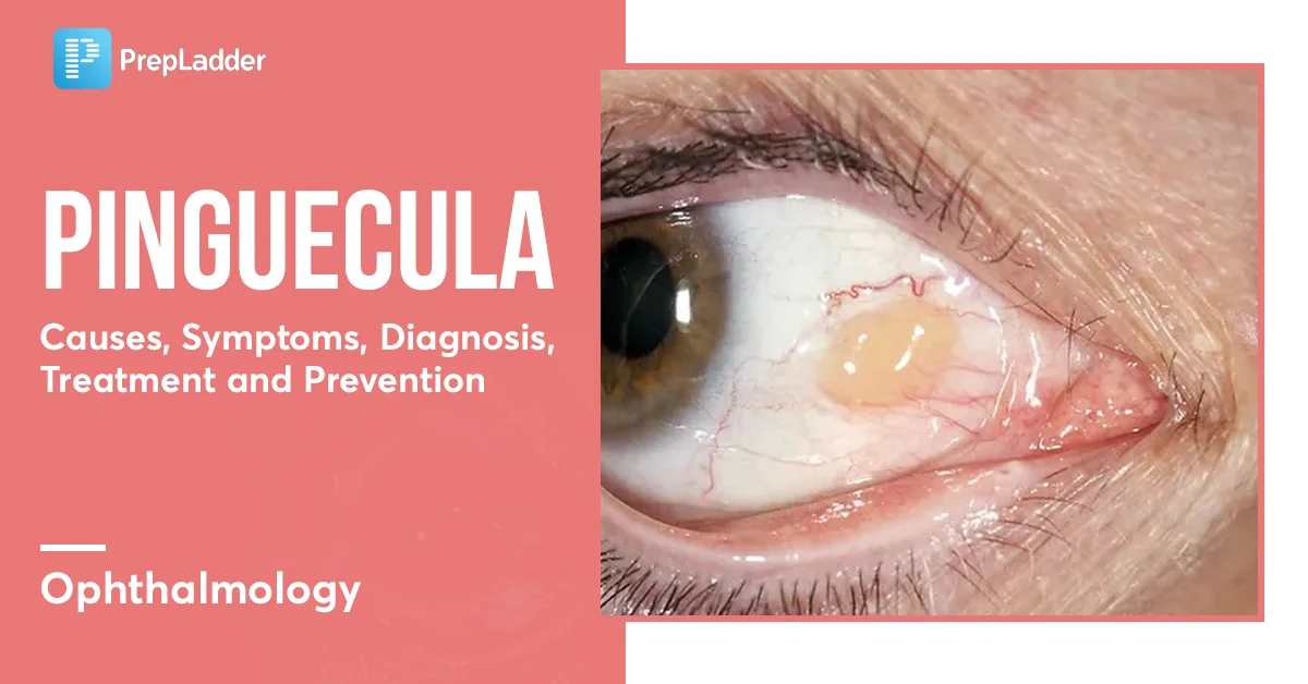 Pinguecula Causes Symptoms Diagnosis Treatment More Pinguecula Causes Symptoms Diagnosis Treatment More
